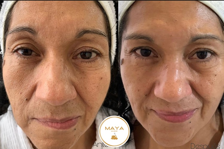 Antes y después de tratamiento facial